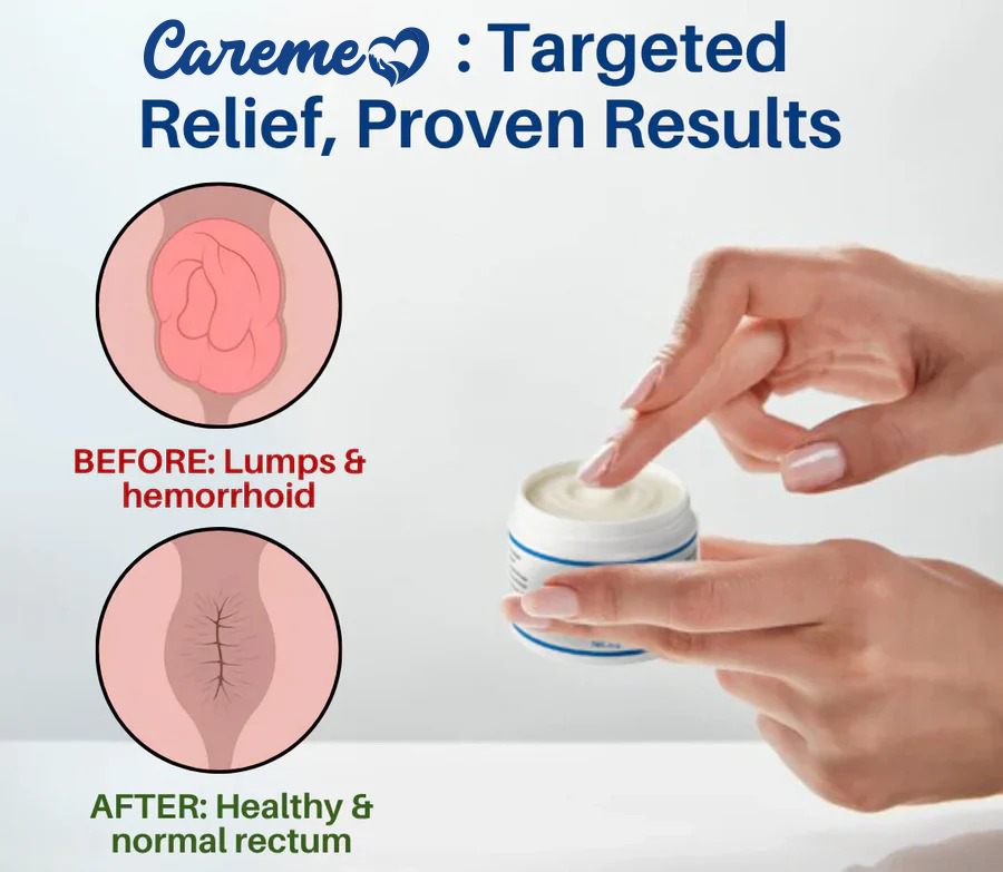 Careme Hemorrhoid & Fissure Cream for Piles