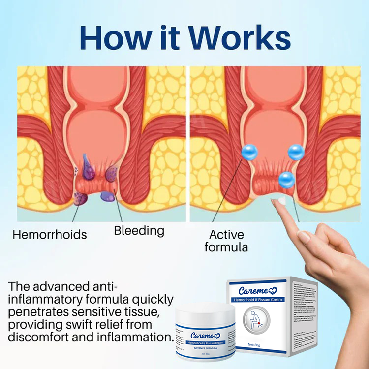 Careme Hemorrhoid & Fissure Cream for Piles